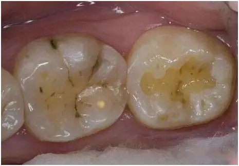 孩子牙齿发黄是虫牙吗 孩子牙齿哪些情况要去看牙医