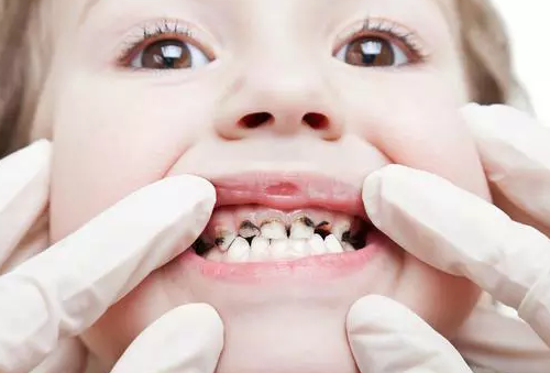我国有五成儿童患龋齿 如何正确保护孩子都是的牙齿不容忽视