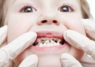 我国有五成儿童患龋齿 如何正确保护孩子都是的牙齿不容忽视