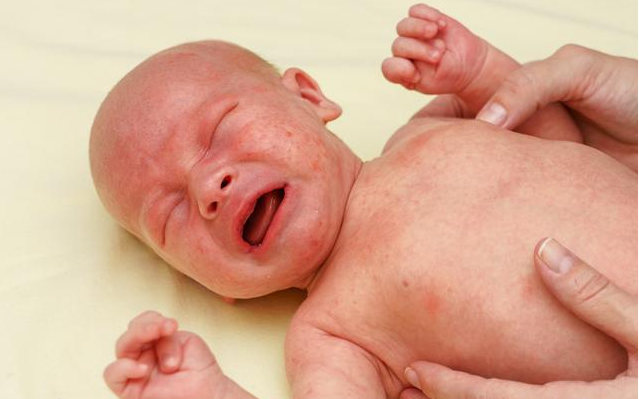 宝宝湿疹反复不好是什么原因 宝宝湿疹反复不好怎么办