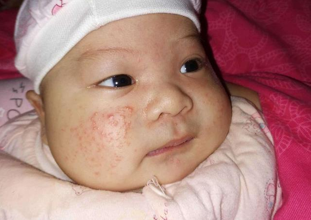 宝宝湿疹反复不好是什么原因 宝宝湿疹反复不好怎么办