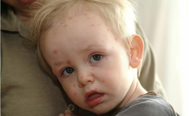水痘潜伏期是多久 孩子得了水痘怎么护理