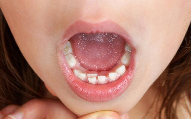 儿童矫正最佳年龄是什么时候 儿童做矫正牙齿后注意事项
