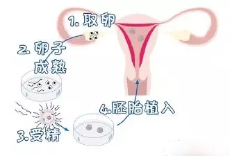[如何做试管婴儿流程]做试管婴儿流程是什么样的 试管婴儿流程步骤