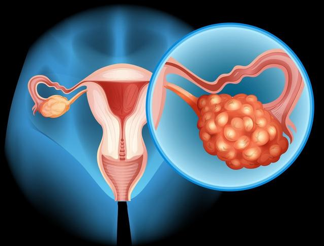卵巢囊肿会自己消失吗 卵巢囊肿不及时治疗有什么后果
