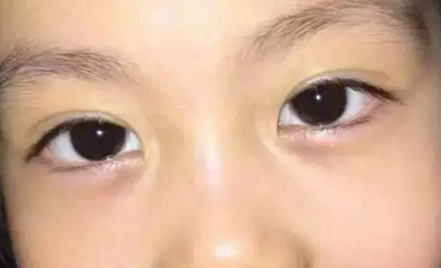 孩子眼袋红容易生病什么原因 孩子眼袋红是阴虚积食吗