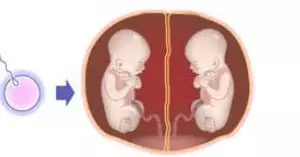 试管婴儿是怎么做到单卵双胎的 单卵双胎有什么风险