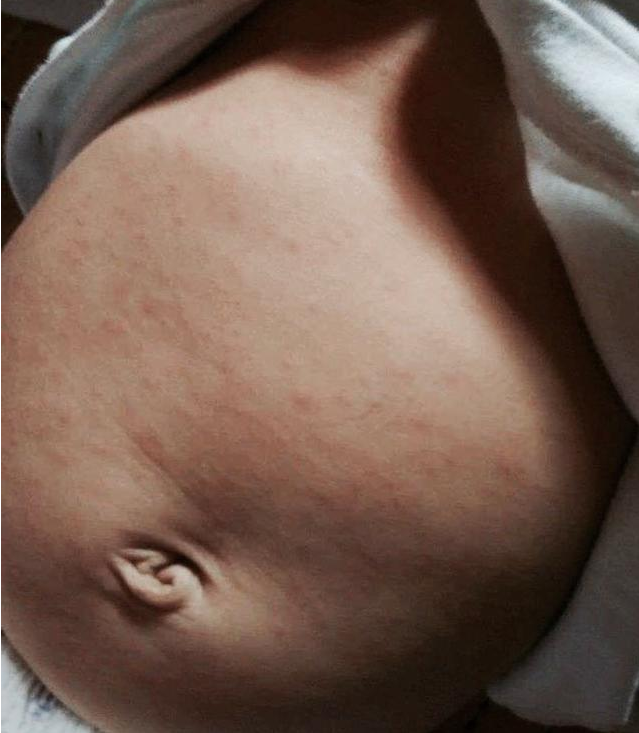 宝宝发烧出疹子是幼儿急疹吗 宝宝幼儿急疹快好了是什么表现