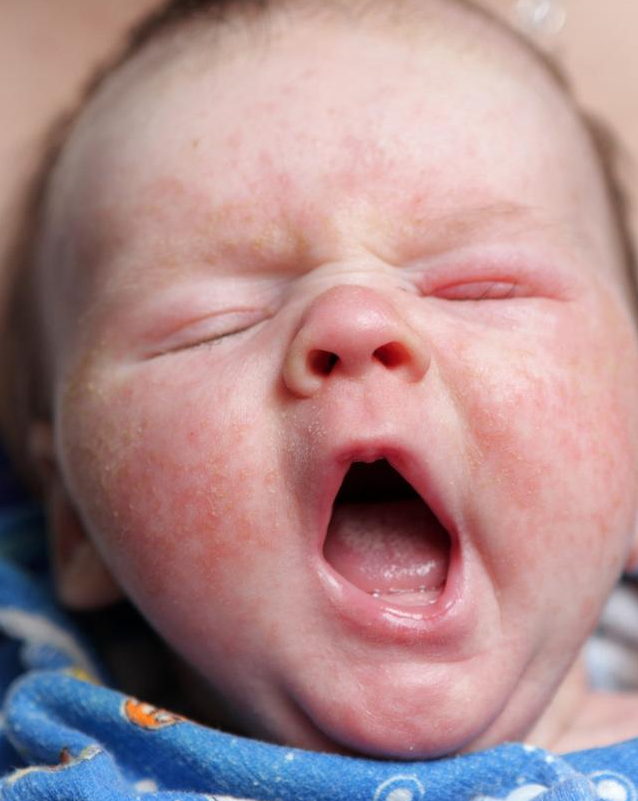 为什么春季宝宝容易得湿疹 如何预防春天孩子长湿疹