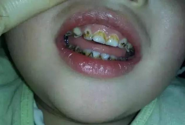 孩子牙齿|孩子牙齿上的黑斑是什么 发现孩子牙齿上有黑点怎么办
