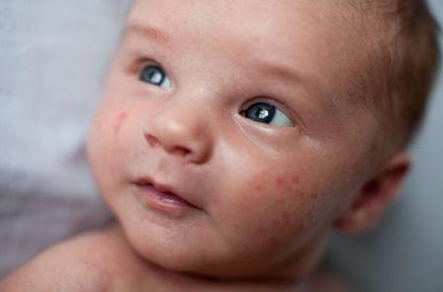 儿童过敏与免疫力有关吗 如何预防儿童过敏