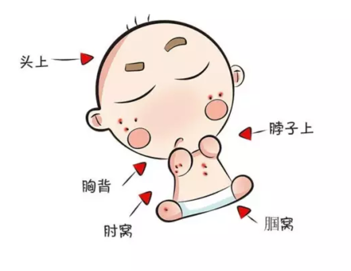 宝宝脓痱子流脓怎么办 宝宝脓痱子感染了怎么治疗