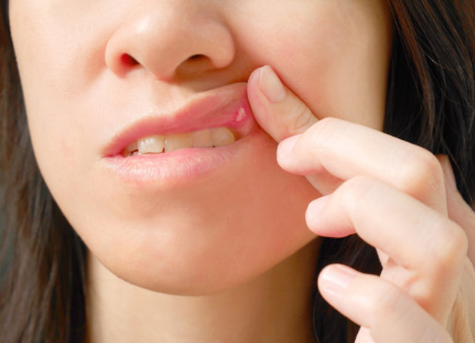 儿童口腔溃疡是什么原因引起的 儿童口腔溃疡该怎么预防