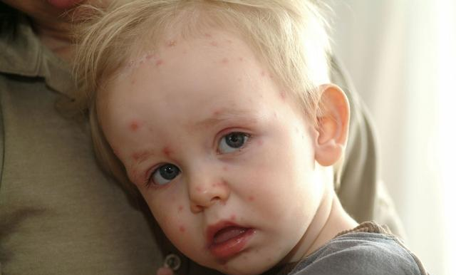 水痘处理不好会留疤吗 孩子长水痘怎么护理