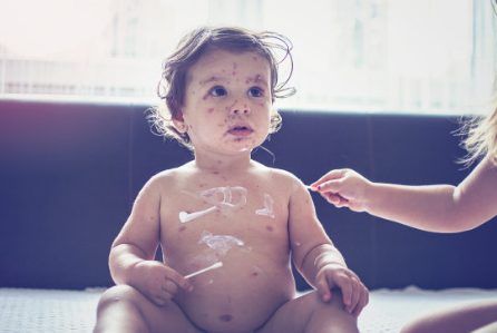 小儿荨麻疹会引起发烧吗 小儿荨麻疹有什么症状