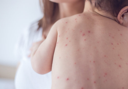 小儿荨麻疹会引起发烧吗 小儿荨麻疹有什么症状