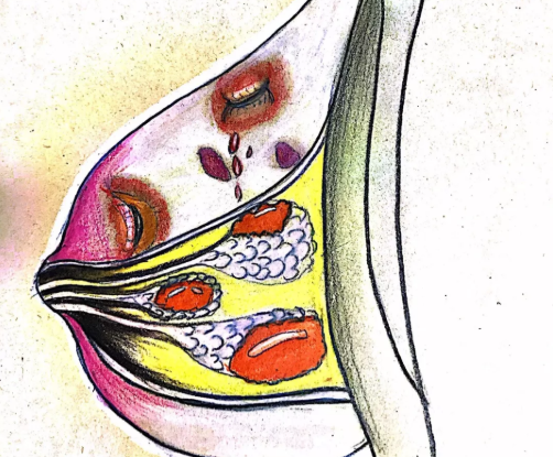乳腺炎脓肿如何照顾宝宝 乳腺炎脓肿能给宝宝喂奶吗