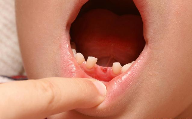 孩子乳牙早失的危害有哪些 孩子乳牙早失怎么办