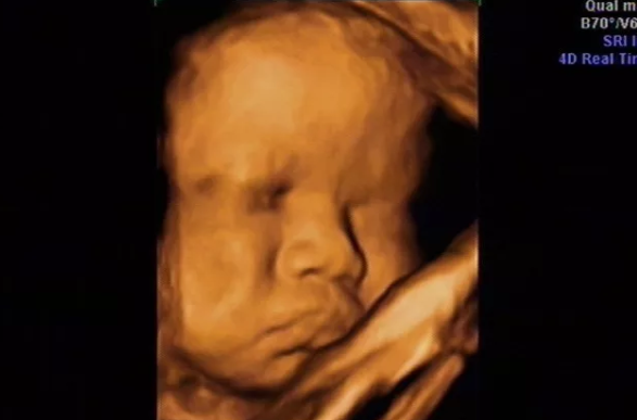 胎儿|胎儿头大是什么原因 胎儿头大的原因