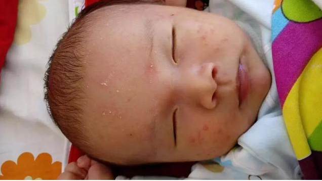 婴儿湿疹可以自愈吗 婴儿湿疹复发怎么办