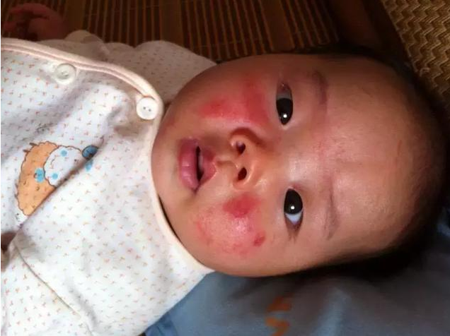 婴儿湿疹可以自愈吗 婴儿湿疹复发怎么办