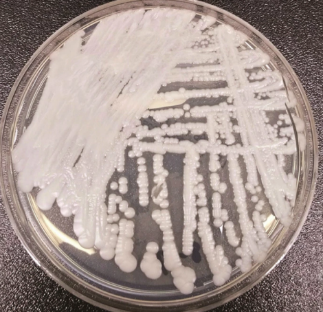 超级真菌容易感染吗 超级真菌怎么预防