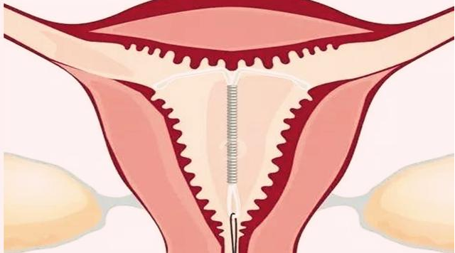 女性绝经取出节育环还需要避孕吗 女性绝经后多久可以取节育环