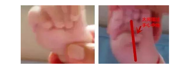 宝宝总攥着拳头正常吗 如何识别不正常的拇指内收