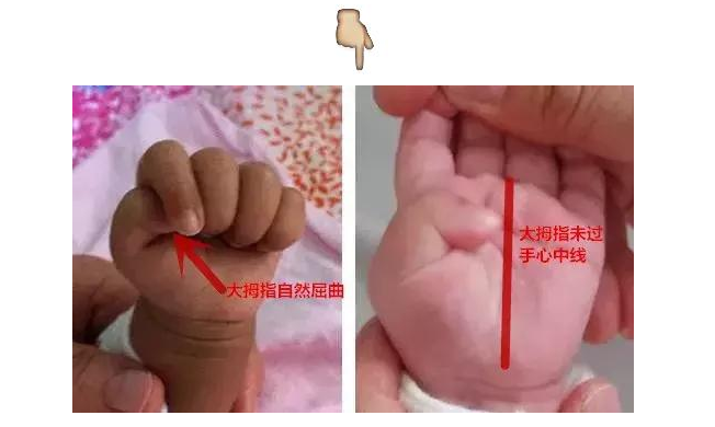 宝宝总攥着拳头正常吗 如何识别不正常的拇指内收
