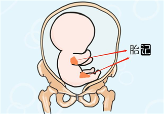 宝宝胎记是怎么形成的 哪些胎记要注意