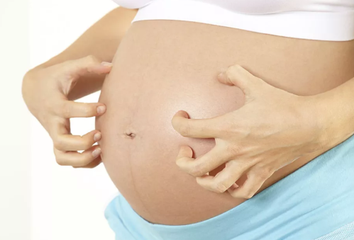 怀孕肚皮瘙痒是因为妊娠纹吗 怀孕肚皮瘙痒一定长妊娠纹吗