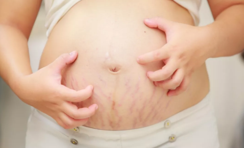 怀孕肚皮瘙痒是因为妊娠纹吗 怀孕肚皮瘙痒一定长妊娠纹吗
