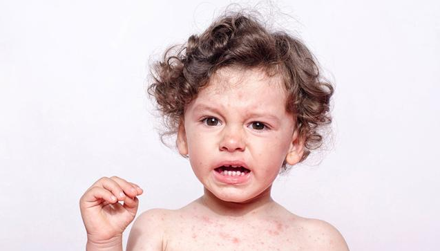如何区分麻疹、风疹、猩红热 麻疹、风疹、猩红热相同点和不同点
