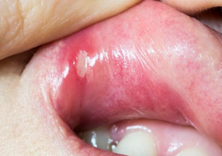 儿童口腔溃疡和便秘有关吗 导致儿童口腔溃疡的因素