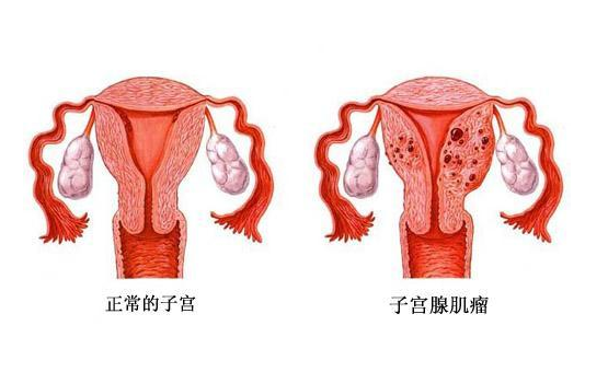子宫腺肌症会导致不孕吗 子宫腺肌症是什么引