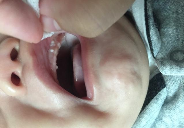 宝宝嘴里的白色东西是鹅口疮吗 怎么区分鹅口疮和奶垢