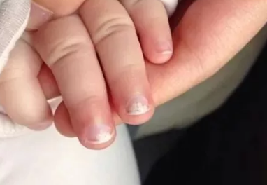 宝宝月牙白点竖纹代表什么呢 宝宝指甲有大秘密