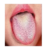 孩子常见草莓舌芒刺怎么推拿 孩子舌苔草莓舌芒刺推拿手法