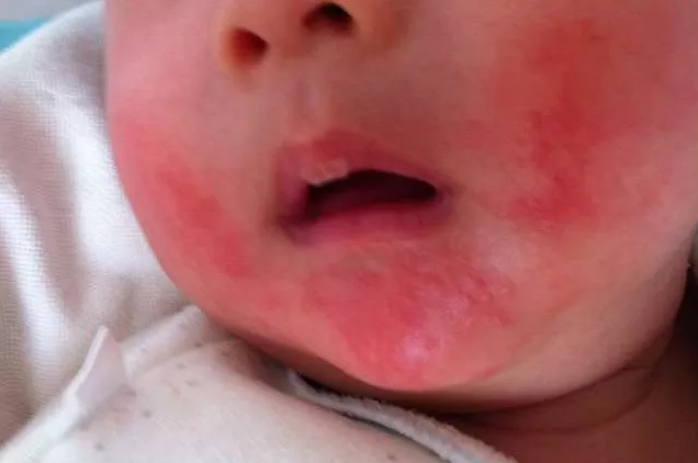 为什么现在孩子特别容易长湿疹 孩子长湿疹的原因是什么