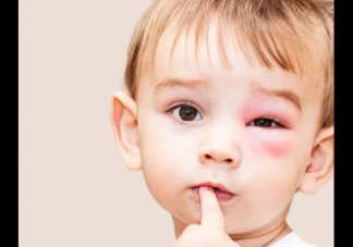 新生儿如何预防宝宝被蚊虫叮咬 孩子被蚊子咬了怎么办