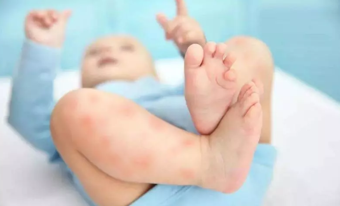 孩子长湿疹吃什么祛湿疹 如何及时预防宝宝湿疹