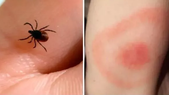 黑腿蜱虫|黑腿蜱虫有什么危害 被蜱虫咬了怎么处理