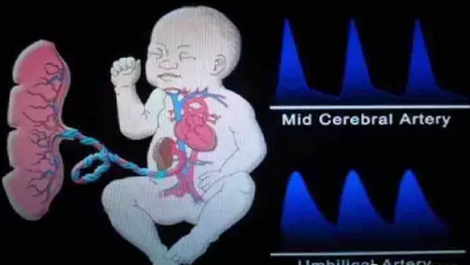 宝宝在子宫内缺氧很危险 如何判断宝宝子宫是否缺氧
