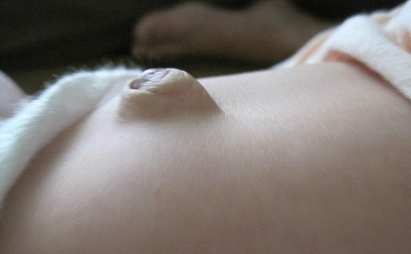 婴儿肚脐鼓出是怎么回事 宝宝肚脐疝需要治疗吗