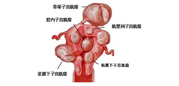怀孕得了子宫肌瘤会影响胎宝宝吗 子宫肌瘤怀