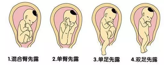 四种胎位不正的情况 有效解决胎位不正的方法