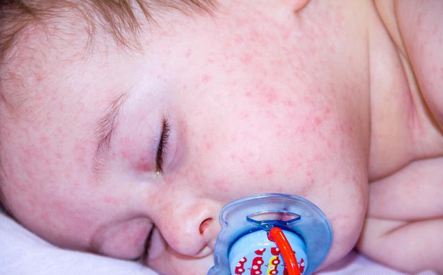 宝宝湿疹的类型有哪些 宝宝湿疹如何护理