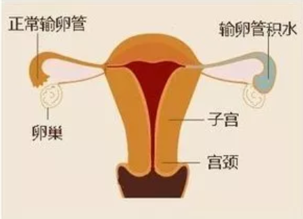 输卵管积水影响怀孕吗 输卵管积水容易流产吗