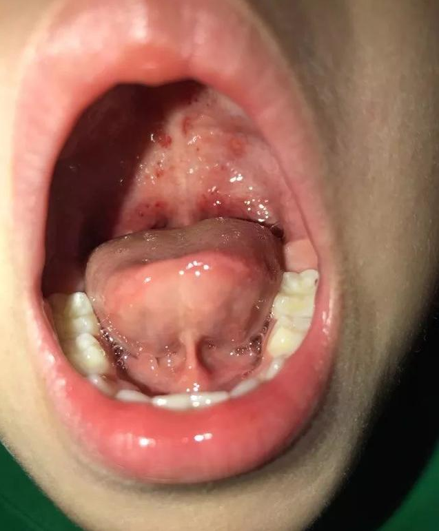小儿疱疹性咽峡炎的症状有哪些 孩子得了疱疹性咽峡炎怎么办