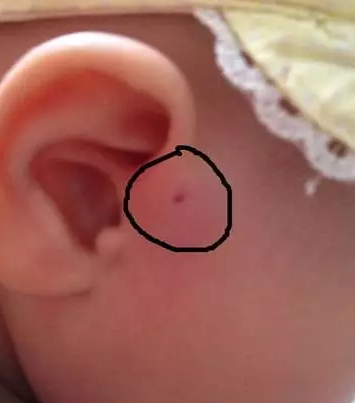 宝宝耳朵上有孔是怎么回事 孩子耳朵上有孔怎么办